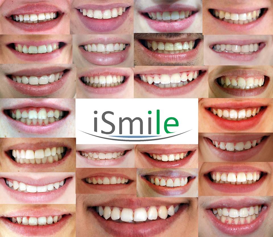 Резултат от ортодонтско лечение в iSmile